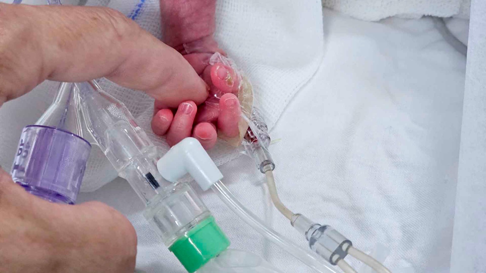 Cirujanos del HEC operaron exitosamente a un bebé prematuro del corazón